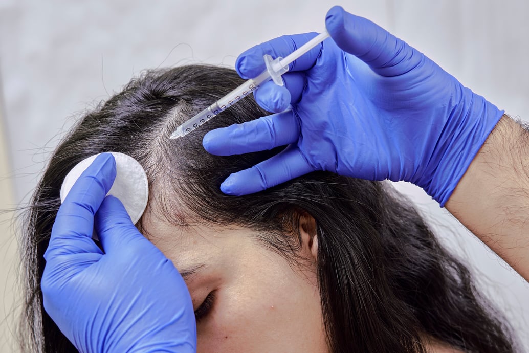 Treatment of hair loss, injection for hair growth. Injected